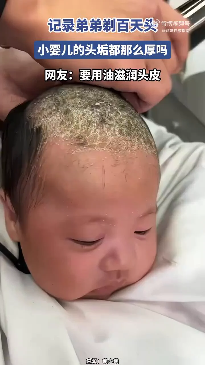 记录弟弟剃百天头，小婴儿的头垢都那么厚吗？？？？ https://t.co/5AML1LQicd