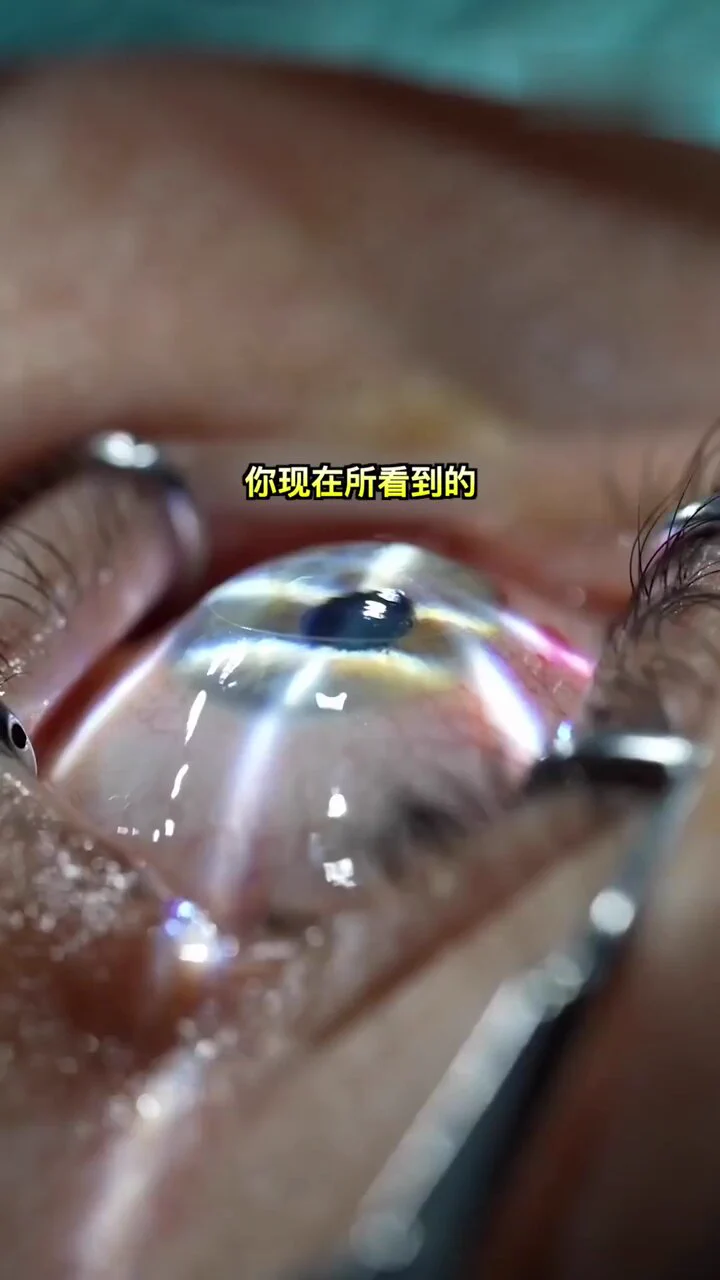 「医学科普：高清镜头下的激光近视手术」