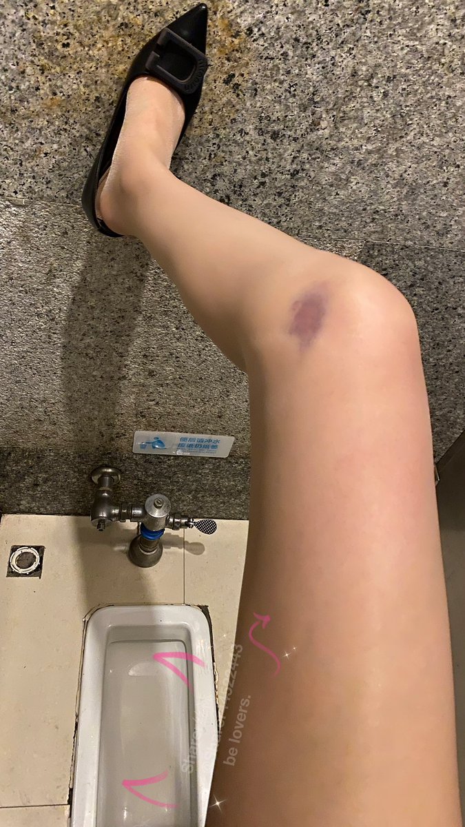 🎀这么大块淤青不知道多久能消，裙子刚好盖不住😢😭。 https://t.co/yv3EEqENOH