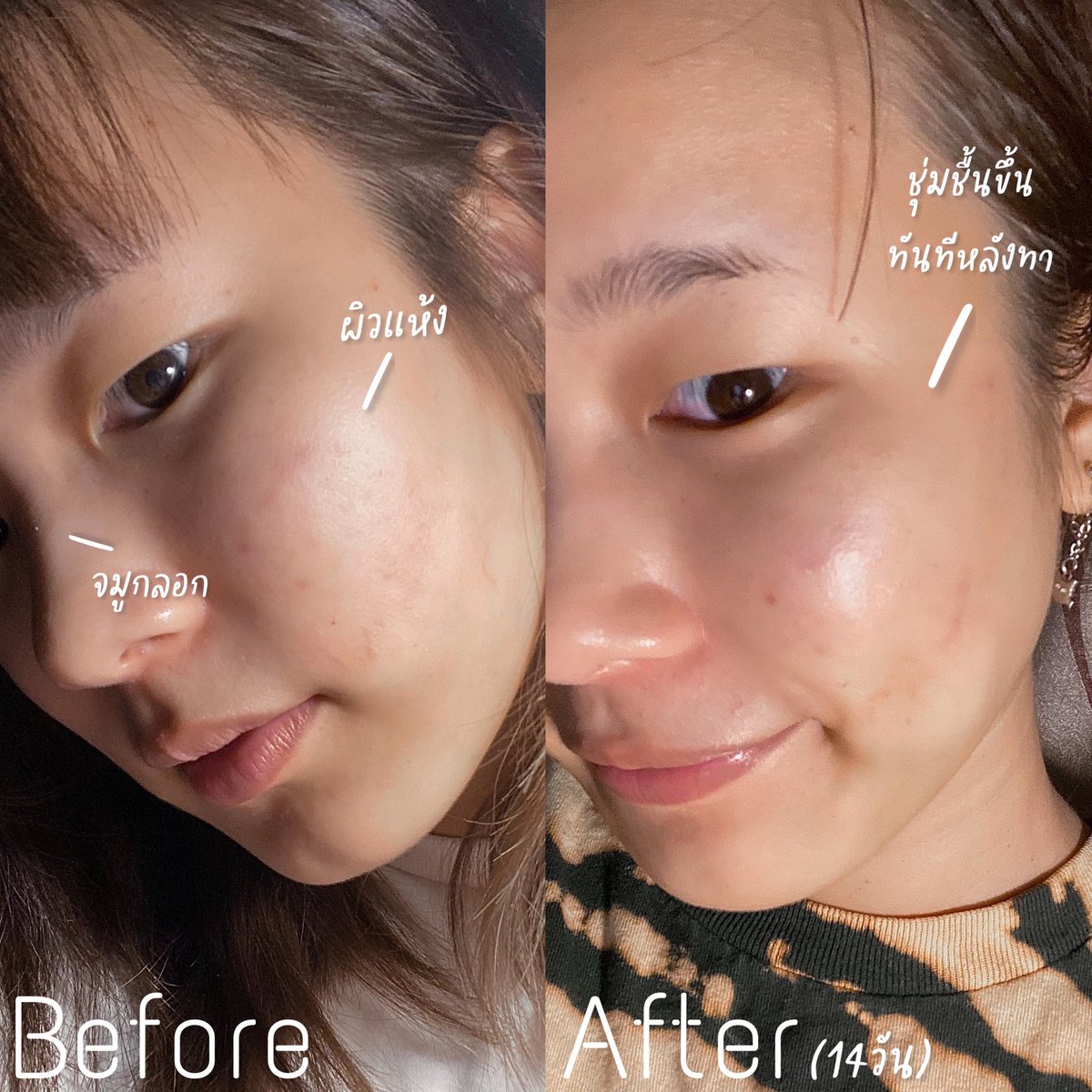 ขอพูดตามจริงเลยว่าหน้าหนาวที่ผ่านมาคือหน้าแห้งมากกก ใช้มาหลายตัวก็เฉยๆ จนมาลองตัวนี้เห้ยยคือแบบมันจิ้งมากกก ไม่คิดว่ามันจะสมคำล่ำลือขนาดนี้! ลองไปครั้งเดียวก็ว่าปังแล้ว นี่ใช้ติดต่อมาเกือบ 2 อาทิตย์รอยสิวลดลงแบบงง ๆ #รีวิว Herhyness #Cleanbeaury #เขาไม่ได้จ้างจ้า #รีวิวเรียลๆ https://t.co/Oib1tLfBZu