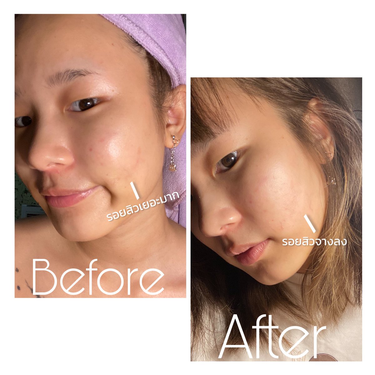 ชอบหน้าตัวเองตอนนี้มากกกก รู้สึกว่าใสขึ้น หลังจากที่ลองใช้เจลแต้มสิวกะมาส์กของ @HerHynessBeauty มันอ่อนโยนสุดไรสุด ใช้แล้วรอยจางไวแบบงงๆอะ ฟิลแบบแต้มไปงั้น แต่จางลงจริง แนะนำมากก
ใครสนใจ พิกัดอยู่นี้ @HerHynessBeauty ลองเถอะแล้วจะติดใจ
#รีวิวherhyness #ใช้ดีบอกต่อ #HowtoPerfect https://t.co/rcxvQP5WgH