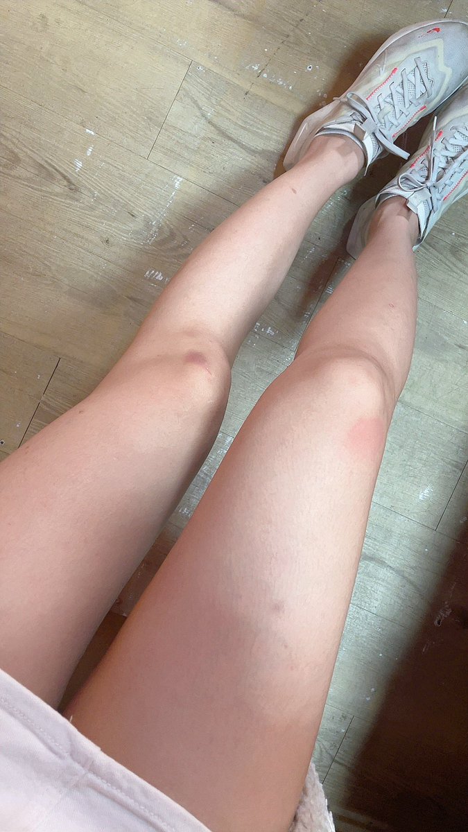 喝完酒的隔天永遠都是滿腳瘀青😅
昨天膝蓋撞一個超痛 https://t.co/7e5WtIjIuq