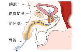 #前列腺高潮 #前高技巧 前列腺高潮快速获得快感方法4:马眼棒刺激。重点要说的是这可能有很大的受伤风险和感染风险，谨慎参考。马眼棒有很多类型，针对前列腺刺激选择坚硬的，能很好刺激前列腺，由于此操作是直接性真正接触性的抵达前列腺，所以快感度会很直接，尽管如此，还是不建议去玩以安全第一 https://t.co/P3mqcUR5ZI