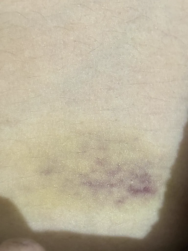 谁爱的淤青来了 https://t.co/euh4T6UABB