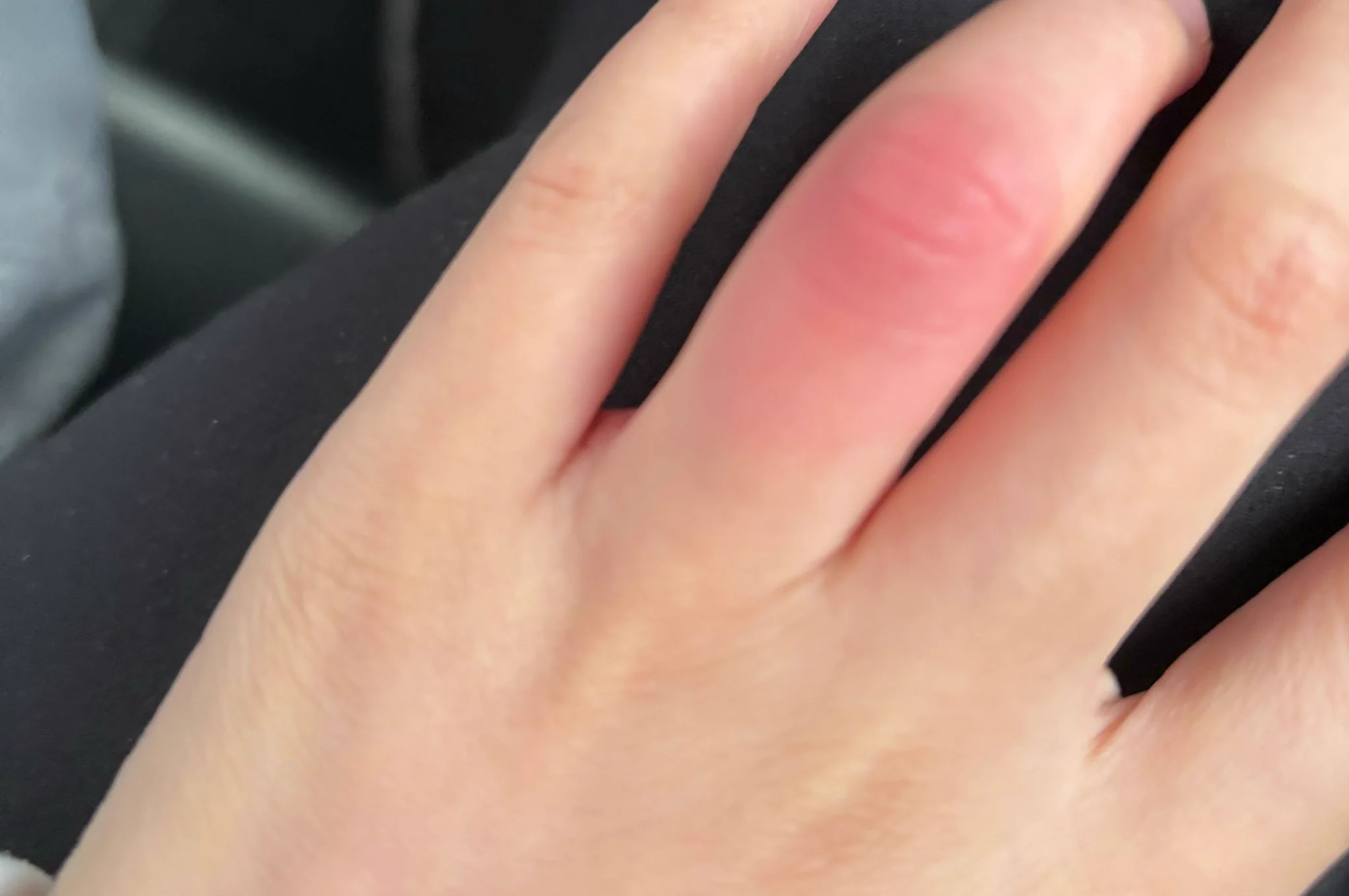 我被毒蚊子咬了😭又疼又痒 https://t.co/L5EWMU3g1m
