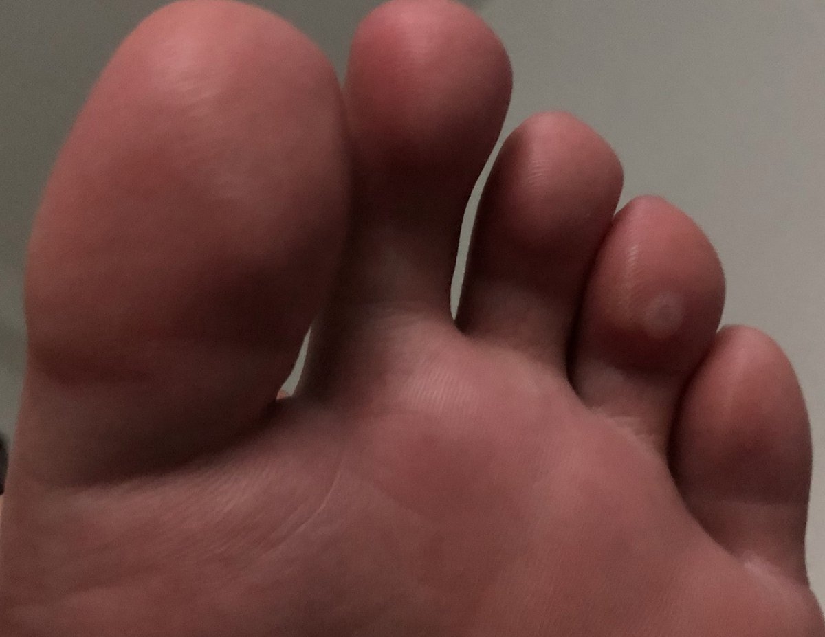 右二他長水泡ㄌ

連續走走走三天
也難怪長一顆超大ㄉ-.- https://t.co/xzrqVw1wMC