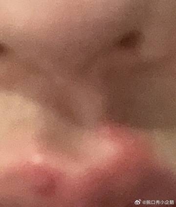 这周前三天陪喝酒陪了三天，后三天病毒性感冒卧床不起，哥们从嘴唇烂到人中🥹一边起泡一边擦鼻涕磨破，全是液体🥹

亏钱亏得免疫力都亏没了🥹活一天算一天吧 https://t.co/JBIiV3hOL3