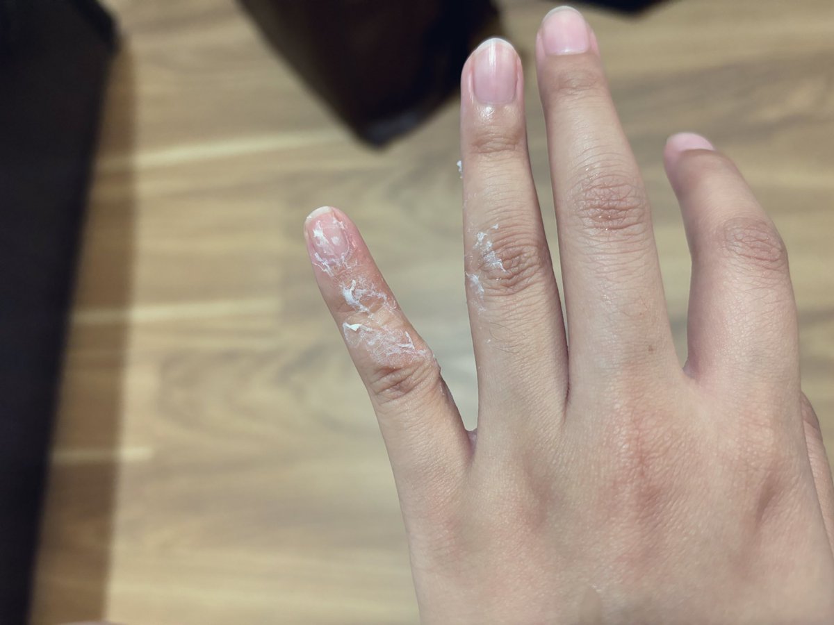 這裡有一個三秒膠黏到手的白痴
剛剛沖了水但已經乾掉了
上網查說用肥皂和溫水
請問有沒有有經驗的推友幫我解答一下怎麼樣可以有效無傷的去除它🥹 https://t.co/wJozlUTXKs