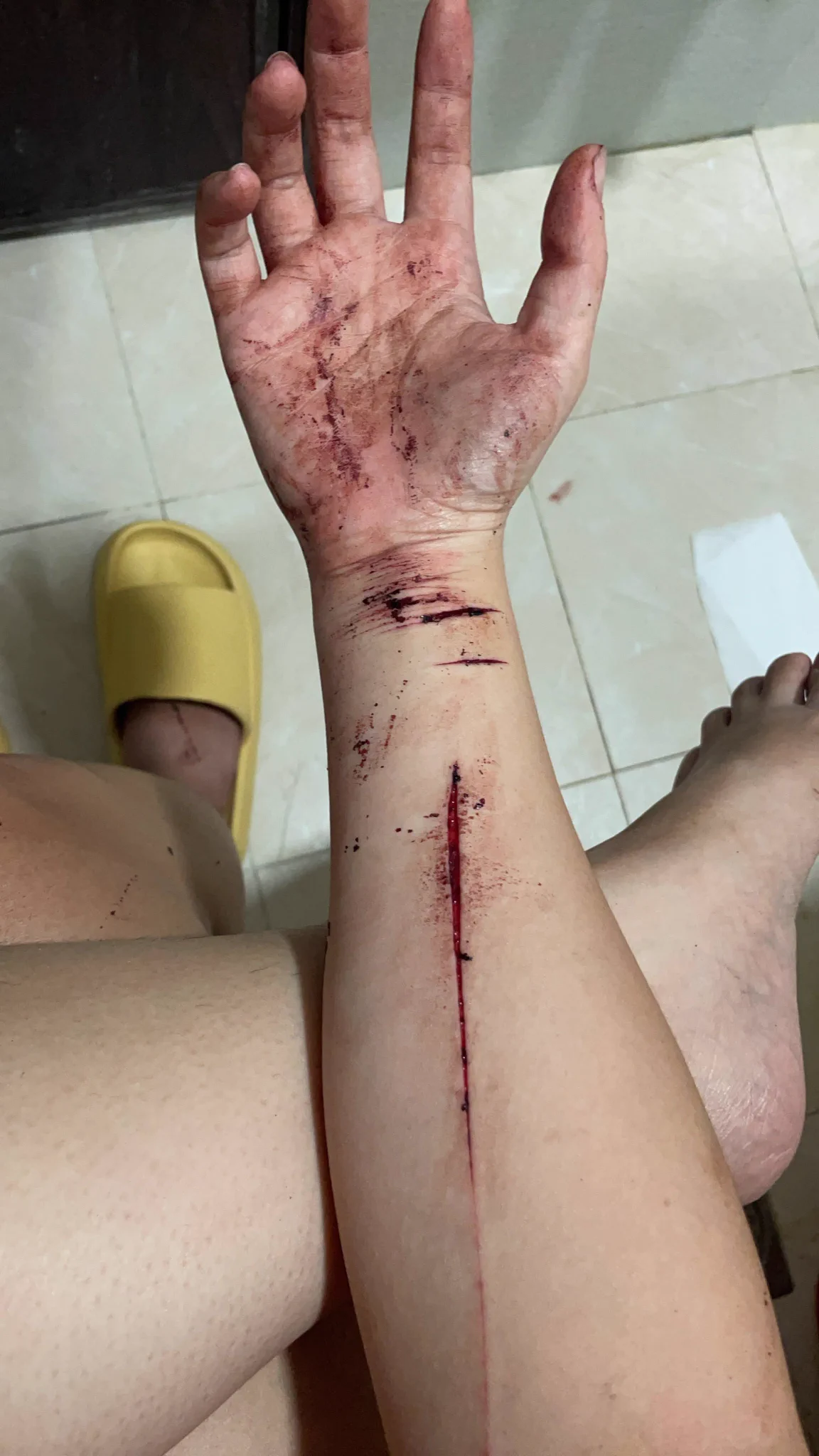 我是位微笑憂鬱症患者😊並且有恐慌和焦慮症、睡眠障礙伴隨，當我傷害過自己看著父母傷心落淚，幡然醒悟要為了愛我的人好好活著才對，就這樣身心疾病依舊纏繞在身邊，但我不再害我愛的和愛我的人落淚。當疾病同時發作時，我也不再傷害自己而是求救、尋求協助、就醫治療。憂鬱症發作是可以到急診的，不要害怕❤️醫生和護理師會幫你打鎮定劑好好休息，不要害怕麻煩別人就悶著自己不就醫，不要覺得一切都只有傷害自己才能解決。病識感很重要，當你覺得自己不對勁時，馬上吃藥或是讓自己求救就醫為優先，這是看到某位妹子的狀態有感而發的文章，我懂那種深不見底的痛苦跟不舒服，還不懂怎麼控制它和平共處時，我做錯了，讓雙手有了見骨而縫上的永久28針傷痕。這不是什麼好炫耀的事情，提起舊事…只為了勸世所有想放棄而傷害自己的人，你/妳都是可以撐過來的，活著沒有不好，至少能看看我這篇文思考一下好嗎？