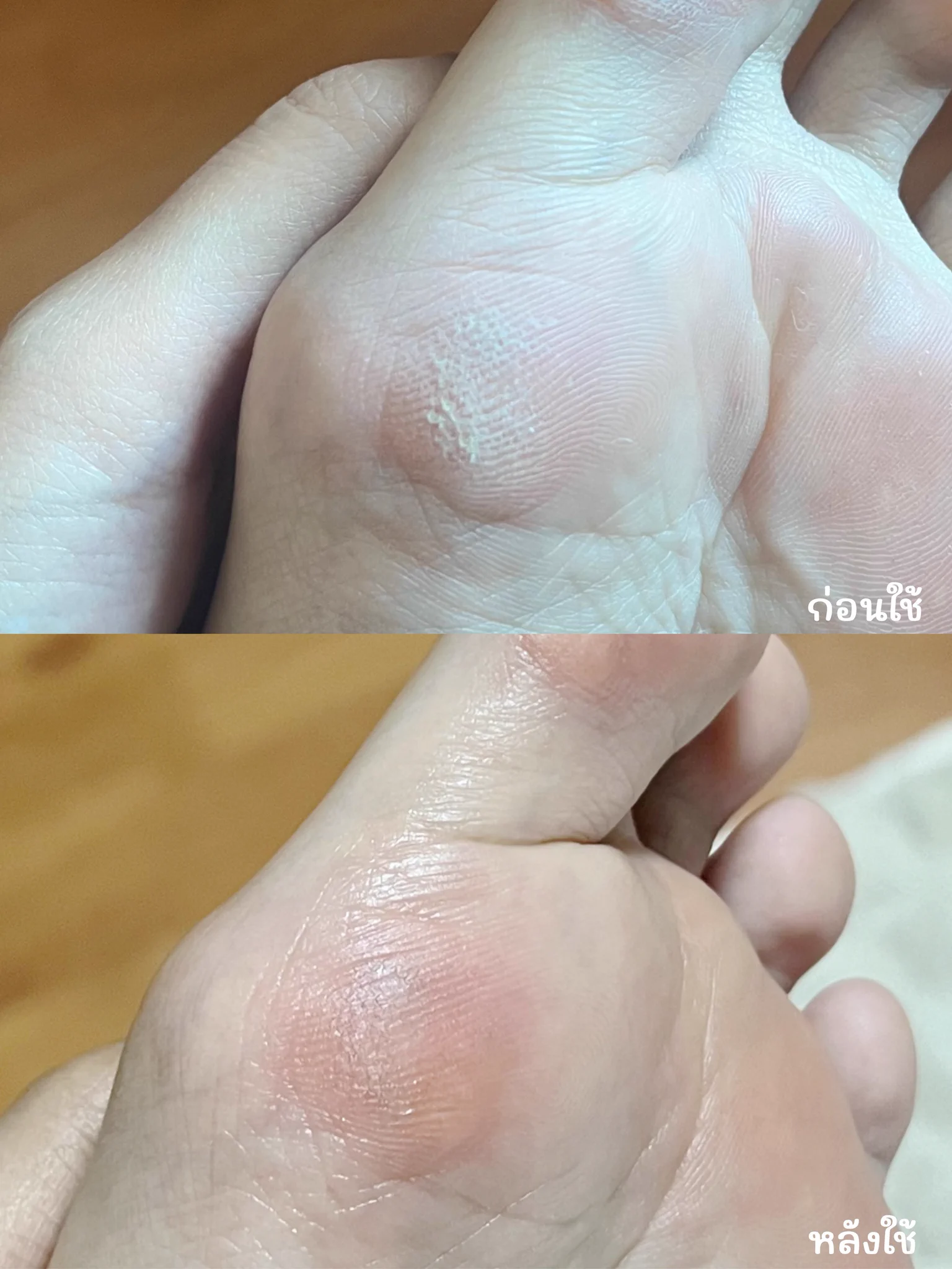 เท้าแห้งแตกเป็นเสี่ยงๆเวอร์ ฟาดยัย Foot Balm ของ L’OCCITANE ไปยังไม่ถึง 5 วัน ผิวนุ่มลงมากกก จากแห้งๆแข็งๆขุยๆ ชีเป็นเชียร์บัตเตอร์เข้มข้น 25% ทาแล้วไม่เหนียวเท้านะ รอซึมแปปนึงแล้วเดินได้ปกติเลย ดีมาก ละกลิ่นคือละมุนหอมเว่ออ https://t.co/tcNCgD9ywB
