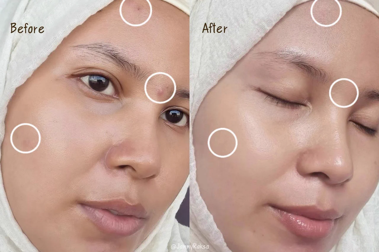 เจอ CURA-MD คู่นี้ไปสิวสงบเลย เห็นแบรนด์มาสักพัก ปกติชอบล้างหน้าด้วยโฟมเซรั่มสูตรลดสิว ช่วยผลัดเซลล์ลดสิวอุดตัน เนื้อโฟมนุ่มมมม ล้างแล้วผิวไม่แห้งเอี๊ยด ผิวยังชุ่มชื้น ละช่วงไหนสิวเป่งๆทาเจลแต้มสิวก่อนนอน ตื่นมาคือสิวยุบละไม่ทิ้งรอยอะ ผิวไม่ลอกไม่แห้ง ช่วยลดการเกิดสิวใหม่ และทั้งคู่เป็นพรีไบโอติก ช่วยเสริมความแข็งแรงของผิว เหมาะสำหรับคนเป็นสิว ผิวแพ้ง่ายใช้ได้เลย