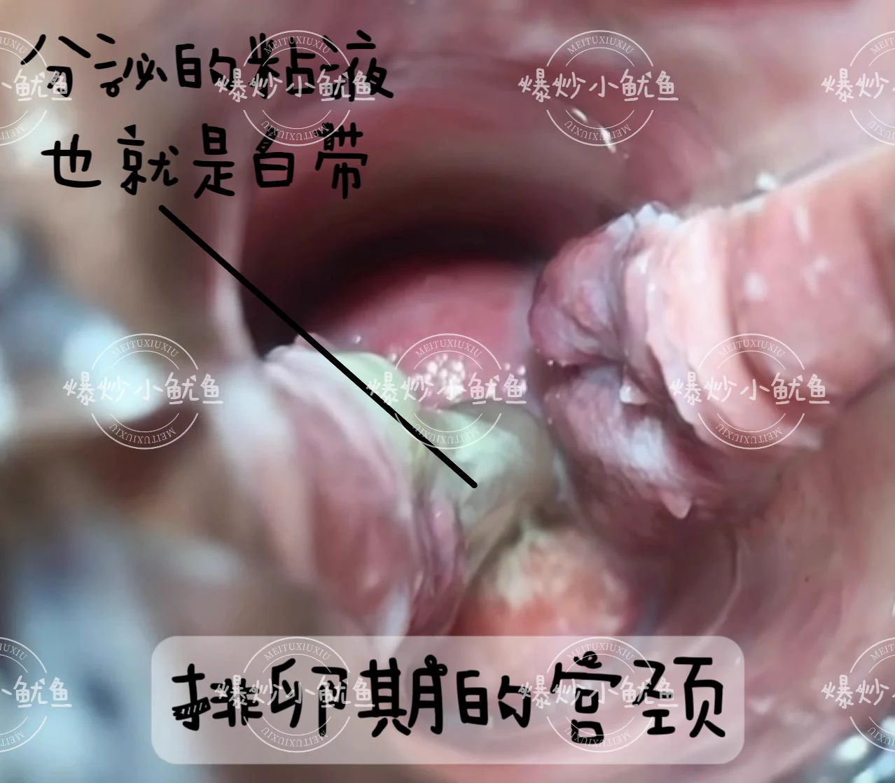 🌸科普贴第五季来咯~~❗关于女生排卵期🌸排卵前的两三天宫颈开始分泌粘液，在激素的作用下粘液会变得非常稀薄，有的时候就像水一样，可能也会呈现拉丝的状态。🌸如果外阴总是湿湿的，内裤上也有拉丝像蛋清一样的白带，就说明快排卵了。🌸过了排卵期孕激素上升，宫颈粘液就会变得粘稠，就会形成一个粘液栓堵在宫颈口。⚠️所以排卵期白带会发生正常变化，比如排卵前期，白带变得充满水分；排卵当天白带透明且粘性强；排卵后白带颜色更白且浓稠。这些变化是身体为怀孕做的正常调整，不用担心。但当白带出现异常时，确实应该警惕并关注。🌸那么如果女朋友下边出现一些黏黏的白带，并不能说明她不爱干净哦，这也都是正常的生理反应，绝对不能说出一些伤人的话哦！PS白浆并不是白带哦~@DaFoer_ @UeeTuip @Daguidiyi @UeeDok @Fojiangnice @UeeWhy