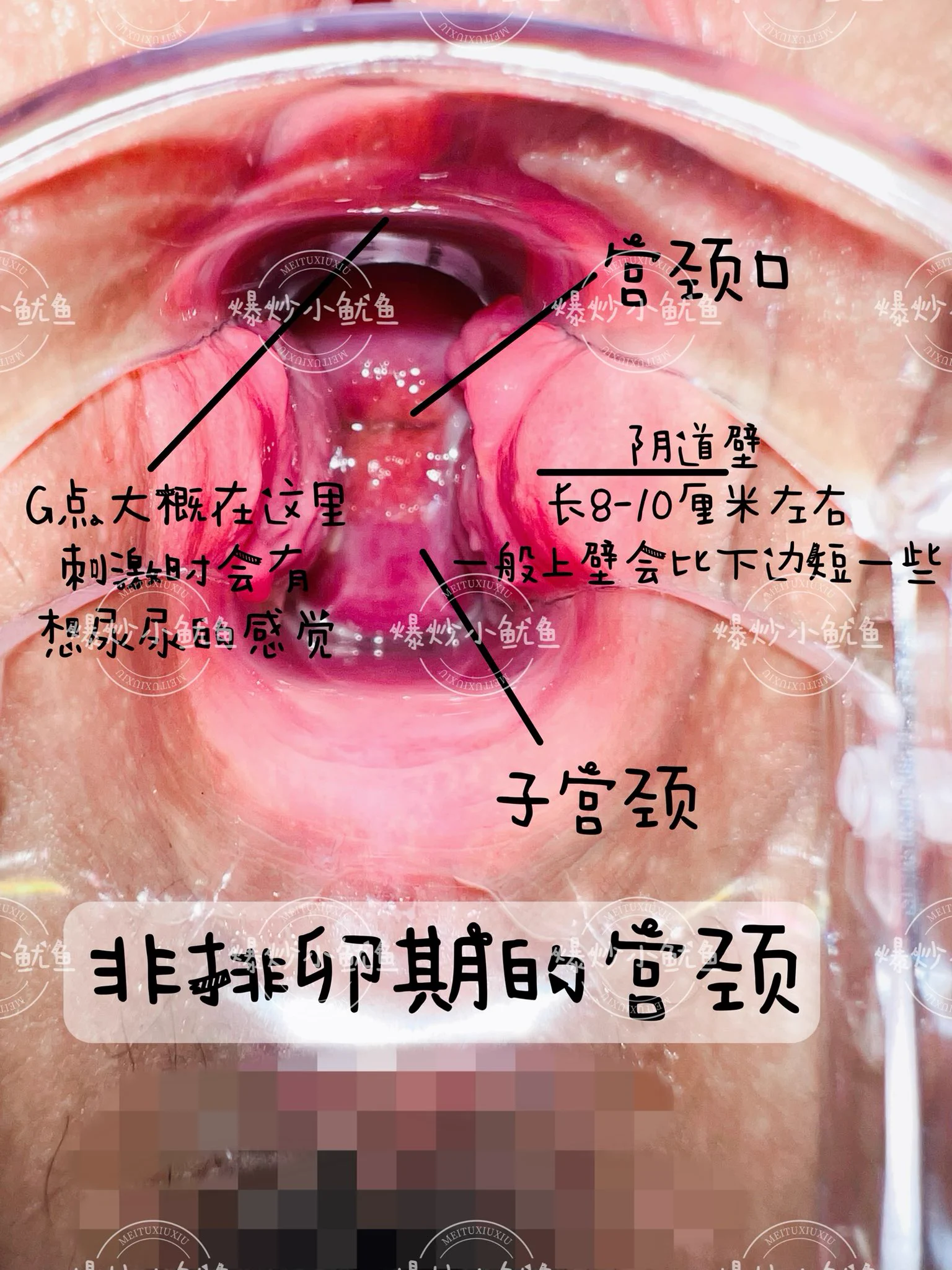 🌸科普贴第五季来咯~~❗关于女生排卵期🌸排卵前的两三天宫颈开始分泌粘液，在激素的作用下粘液会变得非常稀薄，有的时候就像水一样，可能也会呈现拉丝的状态。🌸如果外阴总是湿湿的，内裤上也有拉丝像蛋清一样的白带，就说明快排卵了。🌸过了排卵期孕激素上升，宫颈粘液就会变得粘稠，就会形成一个粘液栓堵在宫颈口。⚠️所以排卵期白带会发生正常变化，比如排卵前期，白带变得充满水分；排卵当天白带透明且粘性强；排卵后白带颜色更白且浓稠。这些变化是身体为怀孕做的正常调整，不用担心。但当白带出现异常时，确实应该警惕并关注。🌸那么如果女朋友下边出现一些黏黏的白带，并不能说明她不爱干净哦，这也都是正常的生理反应，绝对不能说出一些伤人的话哦！PS白浆并不是白带哦~@DaFoer_ @UeeTuip @Daguidiyi @UeeDok @Fojiangnice @UeeWhy