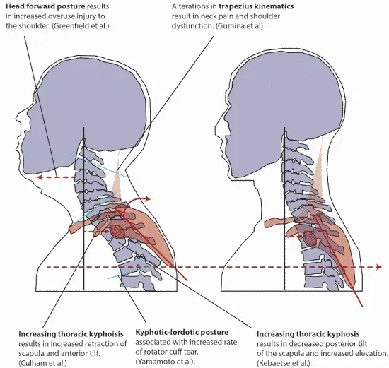 If you're reading this, you probably have forward neck posture.."Nerd neck" makes you dumber, less attractive, and can even cause hair lossHere's how to fix it.. https://t.co/wvMSvAxfr2