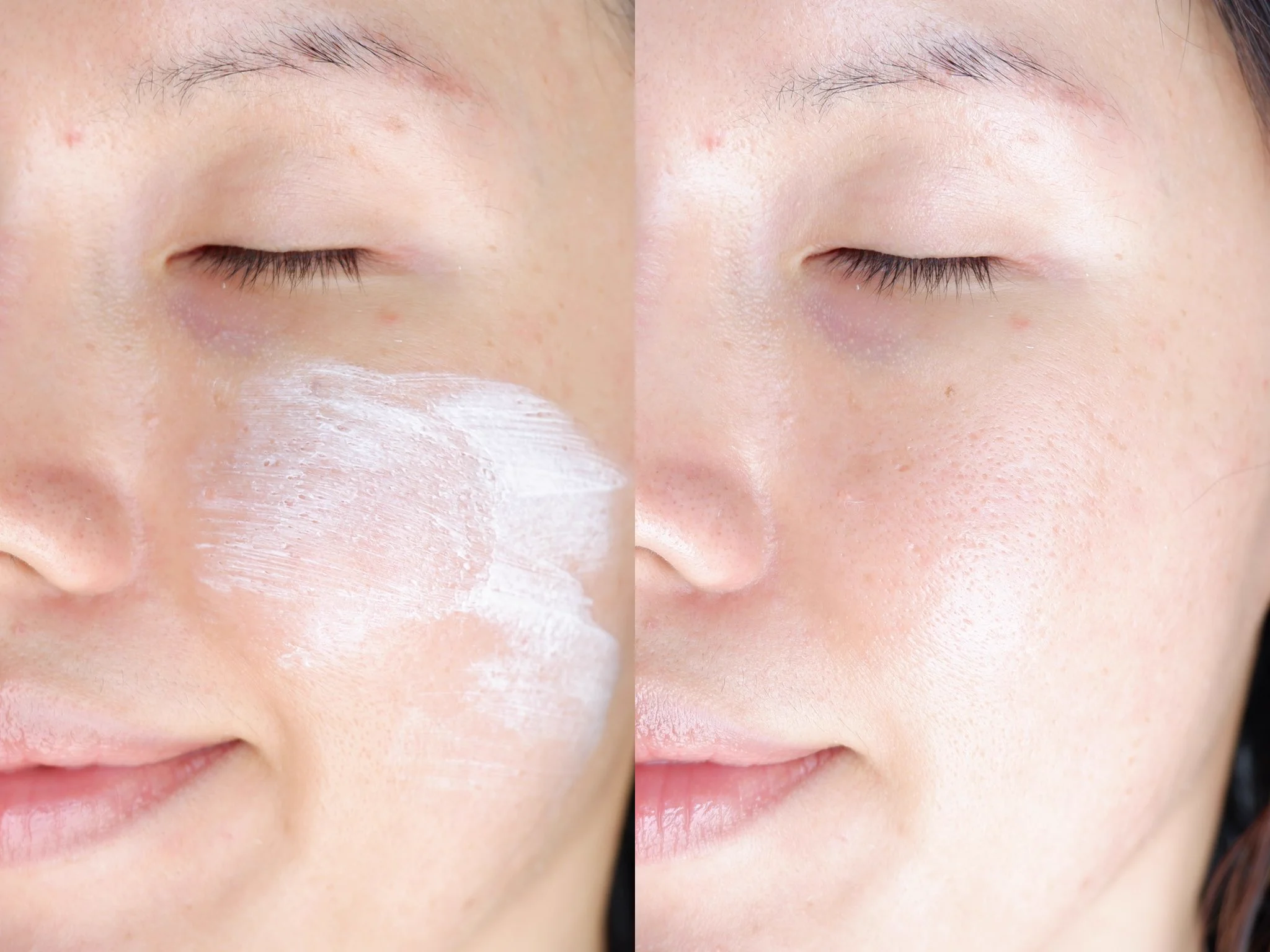 กันแดดสำหรับคนเป็นสิวของคูร่า-เอ็มดี ตัวนี้มีพรีไบโอติก ป้องกันรังสี UVA UVB ใช้แล้วเนื้อบางเบากว่าที่คิดมากๆ เห็นสีขาวเนื้อดูเข้มข้นแบบนี้ แต่จริงๆคือเนียนไปกับผิวเลย ไม่วอก เนื้อลื่นเกลี่ยง่าย ซึมลงผิวแล้วเย็นสบาย ไม่มีความเหนียวหน้าเลย แต่งหน้าต่อได้ไม่เป็นคราบ ใช้ได้ง่ายๆทุกวันนน และไม่อุดตันเลย