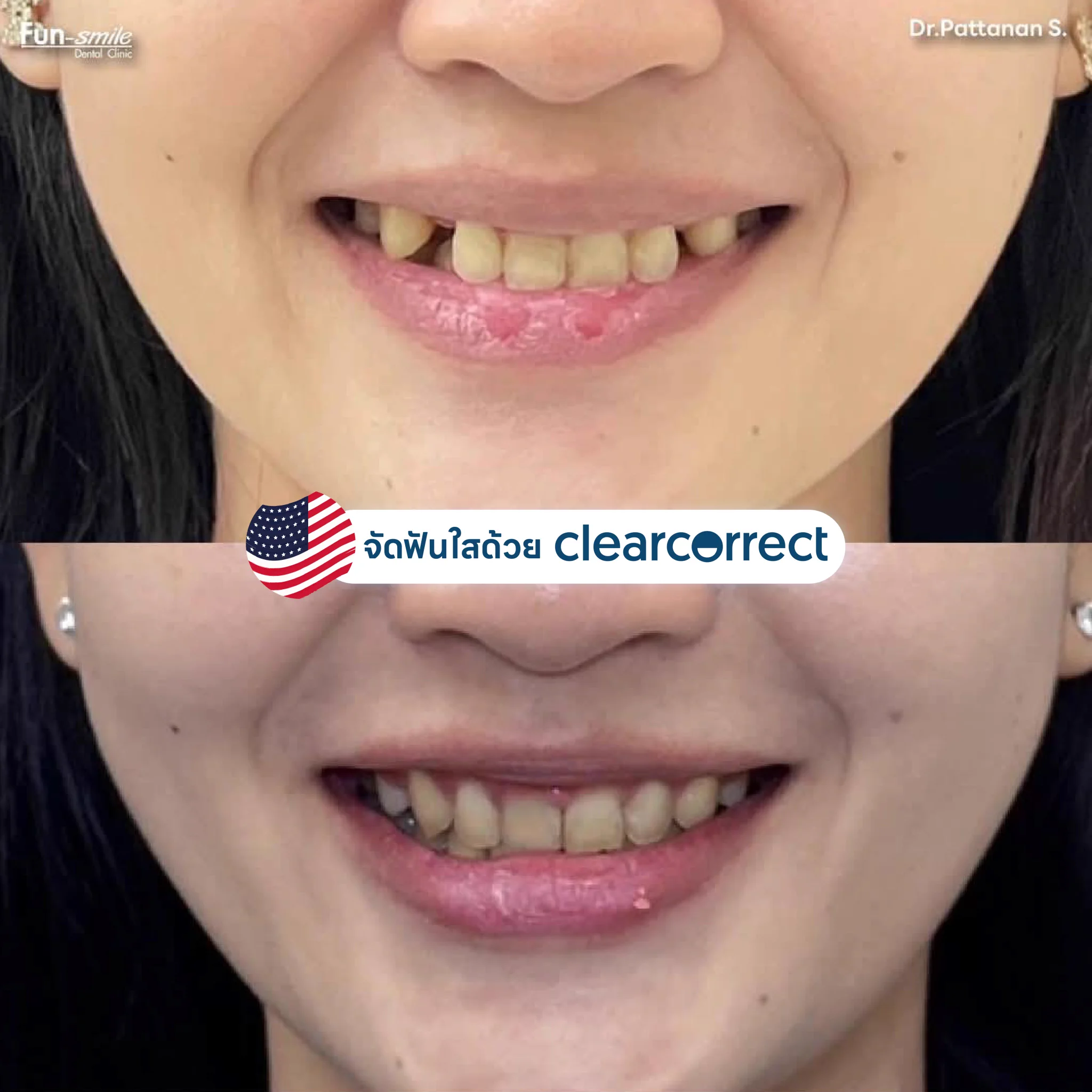 👉จัดฟันใสแก้ฟันยื่น 49,000 แถมฟรีรีเทนเนอร์ USA 🇺🇸มูลค่า 5,000 คุ้มสุดๆ💯✅️แก้ปัญหาฟันหน้าที่ห่างชิด ช่องว่างปิดหมด✅️ฟันบนหุบเข้า ฟันหายยื่น✅️ฟันหน้าล่างเรียงเนียนกริบ หายซ้อนเกClearcorrect by Straumann ที่มีนวัตกรรมวัสดุจัดฟันใสที่ช่วยเคลื่อนฟันไปตามที่หมอออกแบบได้100% และขอบคุณคนไข้ที่มีวินัยในการใส่ชิ้นงานอย่างดีเยี่ยมอยากฟันเข้าเร็วๆ เรียงสวย ไม่อืดอาด หมอยินดีให้คำปรึกษาทุกเคสค่า😘🙏🏻ขอบพระคุณที่เชื่อในฝีมือหมอและไว้วางใจให้ฟันสไมล์ดูแลรอยยิ้มนะคะ💕╔═══════ ════ ════╗👇อยากปรึกษาจัดฟันใส จิ้มเลย👇https://t.co/w7PV7Kz6tphttps://t.co/hhNIAvh8zz╚════════════════╝คลินิกฟันสไมล์ โคราชมี 3 สาขานะคะใกล้ที่ไหนไปที่นั่นได้เลยน๊าาาhttps://t.co/CHAzPTeo9X╔═══════════╗สาขา 1 ในเมือง ถ.อัษฎางค์☎️ 099-159-3500เ ส้ น ท า ง ม า ส า ข า 1https://t.co/UM5mHIWNBK╚═══════════╝╔═══════════╗สาขา ชั้นใต้ดิน เดอะมอลล์โคราช☎️ 095-145-9556เ ส้ น ท า ง ม า ส า ข า เดอะมอลล์https://t.co/7gAduc3vCe╚═══════════╝╔═══════════╗สาขา 3 ในตลาดเซฟวัน☎️ 086-381-7711เ ส้ น ท า ง ม า ส า ข า 3https://t.co/mt3WiHsN3A╚═══════════╝#จัดฟันใส #จัดฟันใสโคราช #จัดฟันแบบใส #invisalign #clearcorrect #วีเนียร์ #วีเนียร์โคราช #ฟอกสีฟัน #ฟอกฟันขาว #รากฟันเทียม #รากฟันเทียมโคราช #straumann #จัดฟัน #จัดฟันเหล็ก #จัดฟันโคราช #วีเนียร์ฉีด #ALLON4 #ALLON6 #ALLONX #overdenture #airflow #GBT #zoom #เลเซอร์เหงือก #ปลูกเหงือก #vista #CTG#neodent