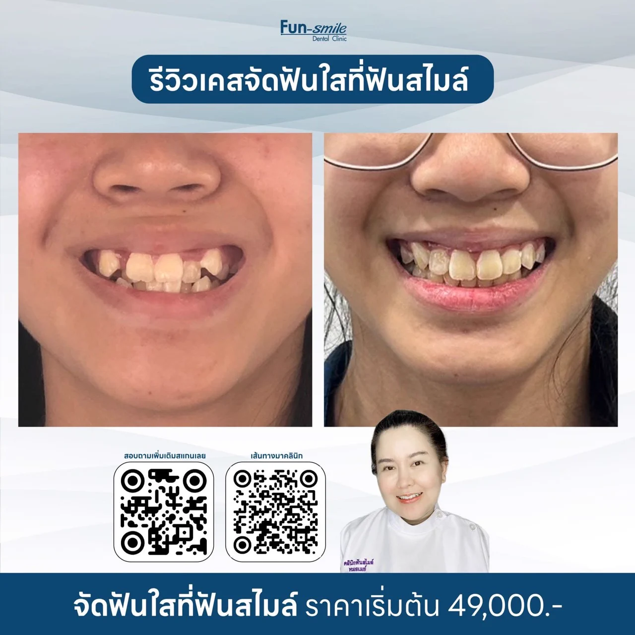 👉จัดฟันใสแก้ฟันยื่น 49,000 แถมฟรีรีเทนเนอร์ USA 🇺🇸มูลค่า 5,000 คุ้มสุดๆ💯✅แก้ปัญหาฟันหน้าที่ห่างชิด ช่องว่างปิดหมด✅ฟันบนหุบเข้า ฟันหายยื่น✅ฟันหน้าล่างเรียงเนียนกริบ หายซ้อนเกClearcorrect by Straumann ที่มีนวัตกรรมวัสดุจัดฟันใสที่ช่วยเคลื่อนฟันไปตามที่หมอออกแบบได้100% และขอบคุณคนไข้ที่มีวินัยในการใส่ชิ้นงานอย่างดีเยี่ยมอยากฟันเข้าเร็วๆ เรียงสวย ไม่อืดอาด หมอยินดีให้คำปรึกษาทุกเคสค่า😘🙏🏻ขอบพระคุณที่เชื่อในฝีมือหมอและไว้วางใจให้ฟันสไมล์ดูแลรอยยิ้มนะคะ💕╔═══════ ════ ════╗👇อยากปรึกษาจัดฟันใส จิ้มเลย👇https://t.co/w7PV7Kz6tphttps://t.co/hhNIAvh8zz╚════════════════╝คลินิกฟันสไมล์ โคราชมี 3 สาขานะคะใกล้ที่ไหนไปที่นั่นได้เลยน๊าาาhttps://t.co/BZRoRqAXiC╔═══════════╗สาขา 1 ในเมือง ถ.อัษฎางค์☎️ 099-159-3500เ ส้ น ท า ง ม า ส า ข า 1https://t.co/UM5mHIWNBK╚═══════════╝╔═══════════╗สาขา ชั้นใต้ดิน เดอะมอลล์โคราช☎️ 095-145-9556เ ส้ น ท า ง ม า ส า ข า เดอะมอลล์https://t.co/7gAduc3vCe╚═══════════╝╔═══════════╗สาขา 3 ในตลาดเซฟวัน☎️ 086-381-7711เ ส้ น ท า ง ม า ส า ข า 3https://t.co/mt3WiHsN3A╚═══════════╝#จัดฟันใส #จัดฟันใสโคราช #จัดฟันแบบใส #invisalign #clearcorrect #วีเนียร์ #วีเนียร์โคราช #ฟอกสีฟัน #ฟอกฟันขาว #รากฟันเทียม #รากฟันเทียมโคราช #straumann #จัดฟัน #จัดฟันเหล็ก #จัดฟันโคราช #วีเนียร์ฉีด #ALLON4 #ALLON6 #ALLONX #overdenture #airflow #GBT #zoom #เลเซอร์เหงือก #ปลูกเหงือก #vista #CTG#neodent