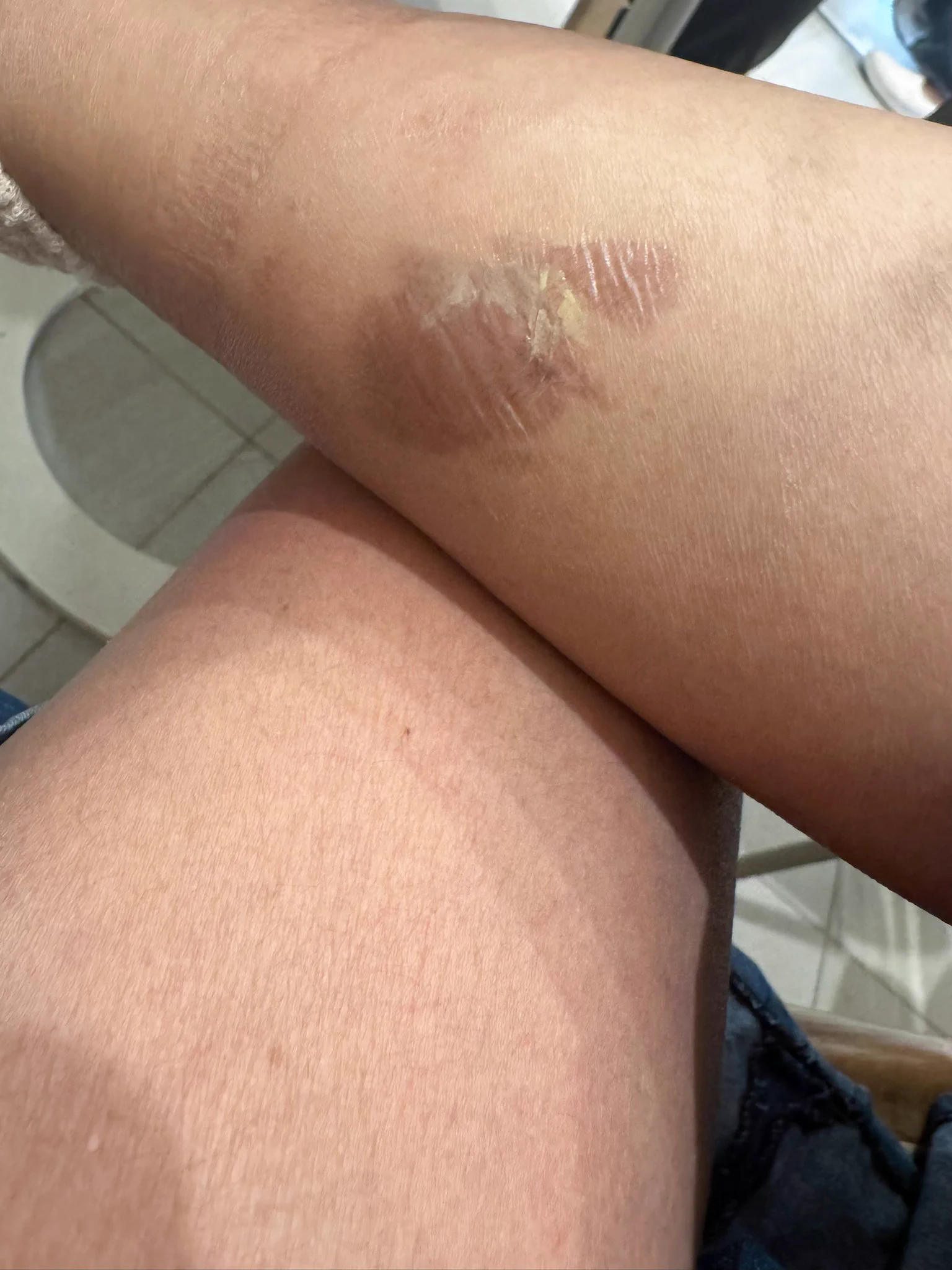 新年就出事…..昨天被違停機車排煙管燙傷了🥲🛵好大一片好痛嗚嗚😭 https://t.co/kEUlxhPEDV