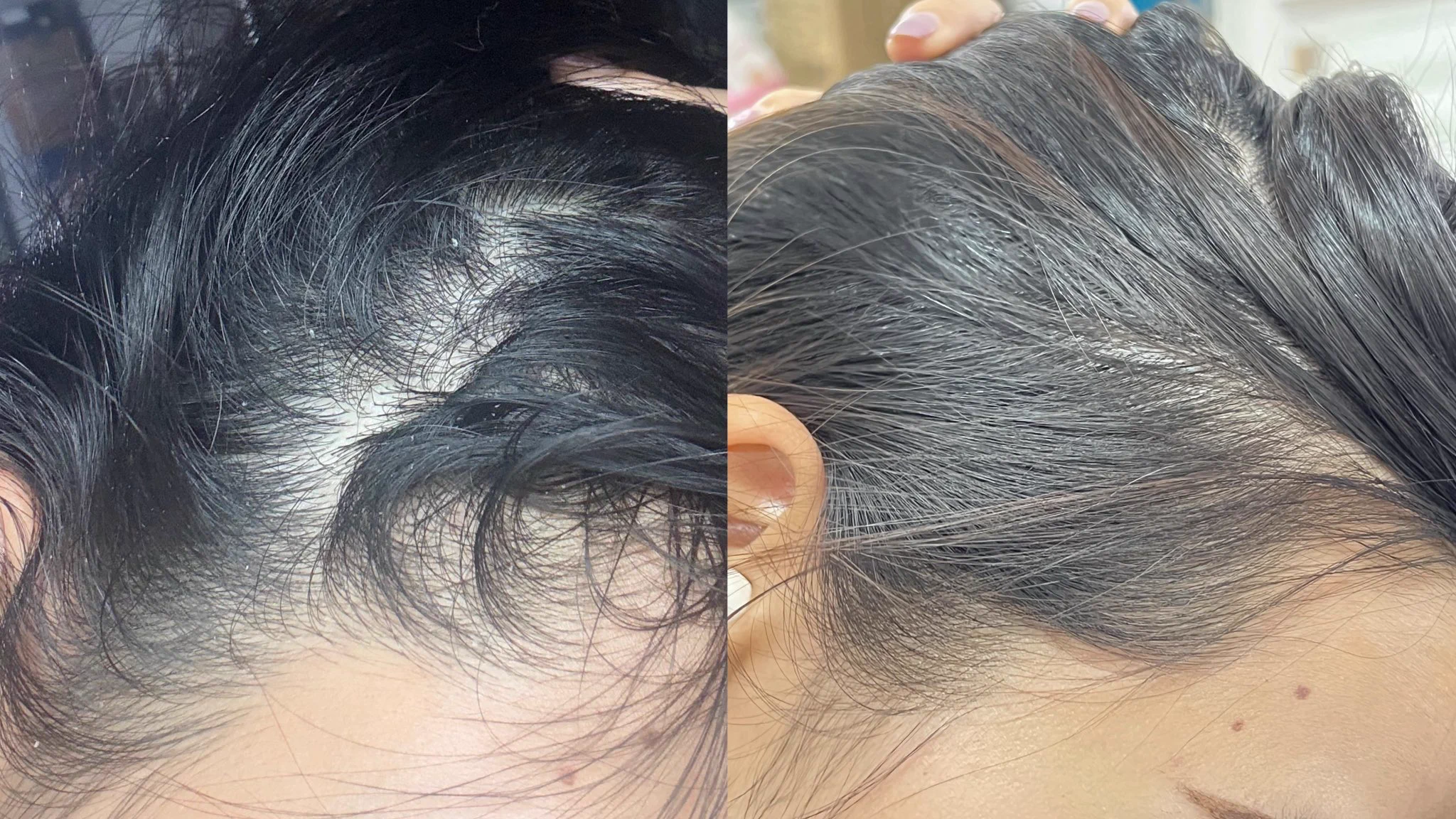 ขวดที่สามแล้วจ้า เอาดีป้ายยา Vichy Dercos ไปหลายคนมากเห็นผลดีเรื่องรังแค หนังศรีษะลอก จากใจคนใช้จริงๆนะ แค่อาทิตย์เดียวก็เริ่มเห็นผลแล้วอะ แล้วหายเป็นรังแคไปอีกนาน เหมาะมากกับคนหัวแห้ง เพราะรู้สึกหัวชุ่มชื่นขึ้นน ซื้อละไม่เสียดายเงินเลยอะคุ้มมม https://t.co/YZjgBZzLRj