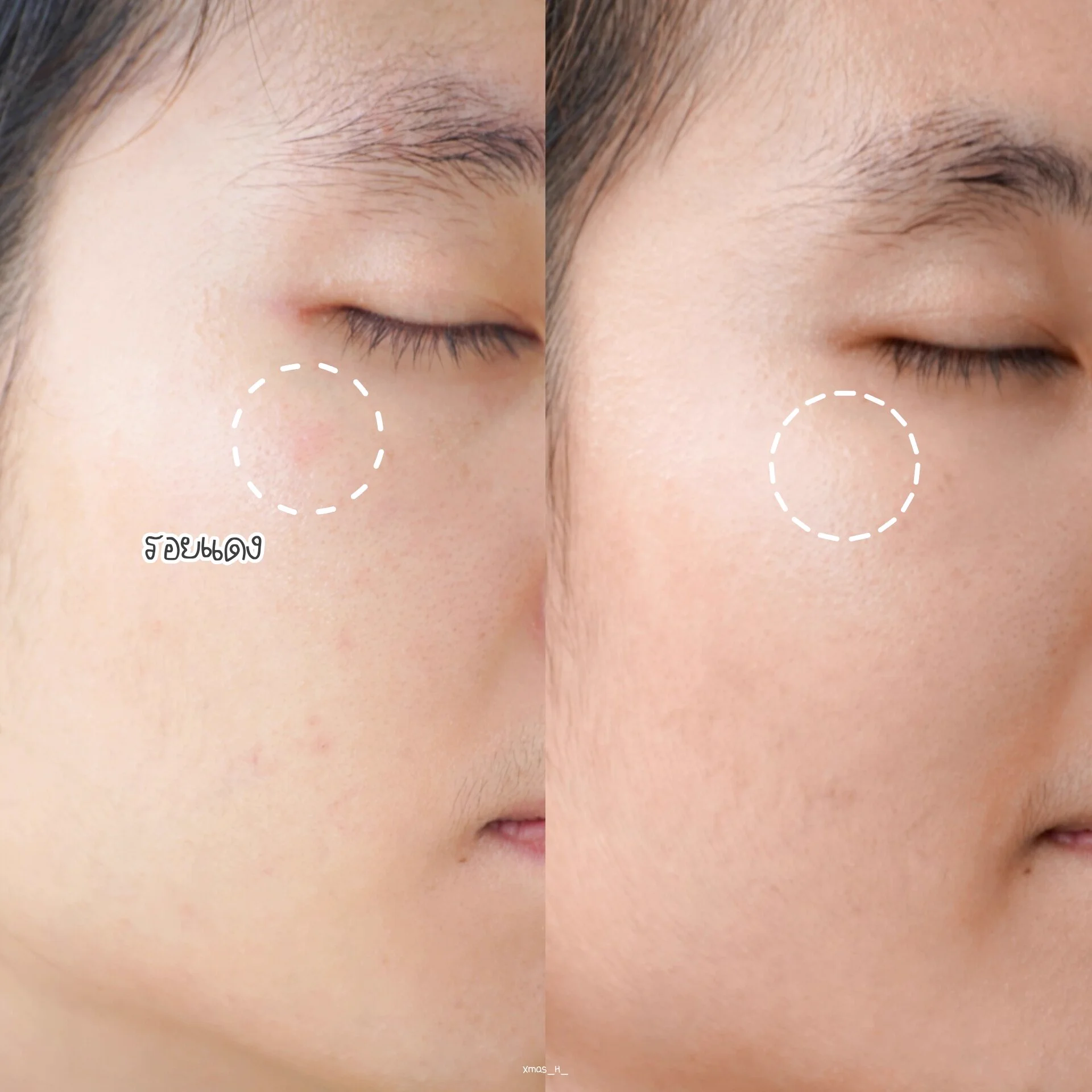เป็นครีมที่ควรมีทุกบ้านมากๆ นี่โบก La Roche-Posay Cicaplast Baume B5+ เช้า-เย็น ​ประมาณ 3-4 วัน รอยแดงหายไปแล้ว คือหายไวแทบไม่ต้องพักหน้านาน ใครผิวแห้ง ผิวโทรม หรือแพ้อะไรมาหยิบตัวนี้มาทาได้เลยนะคับ ช่วยลดรอยแดง การอักเสบ ผิวอิ่มฟู กู้ผิวได้ดีมากจริงๆ ขออวย! 💖#HowtoPerfect #ใช้ดีบอกต่อ #LaRochePosayTH #Cicaplast #ลาโรชโพเซย์ #ซิคาพลาส #CicaplastSPF50