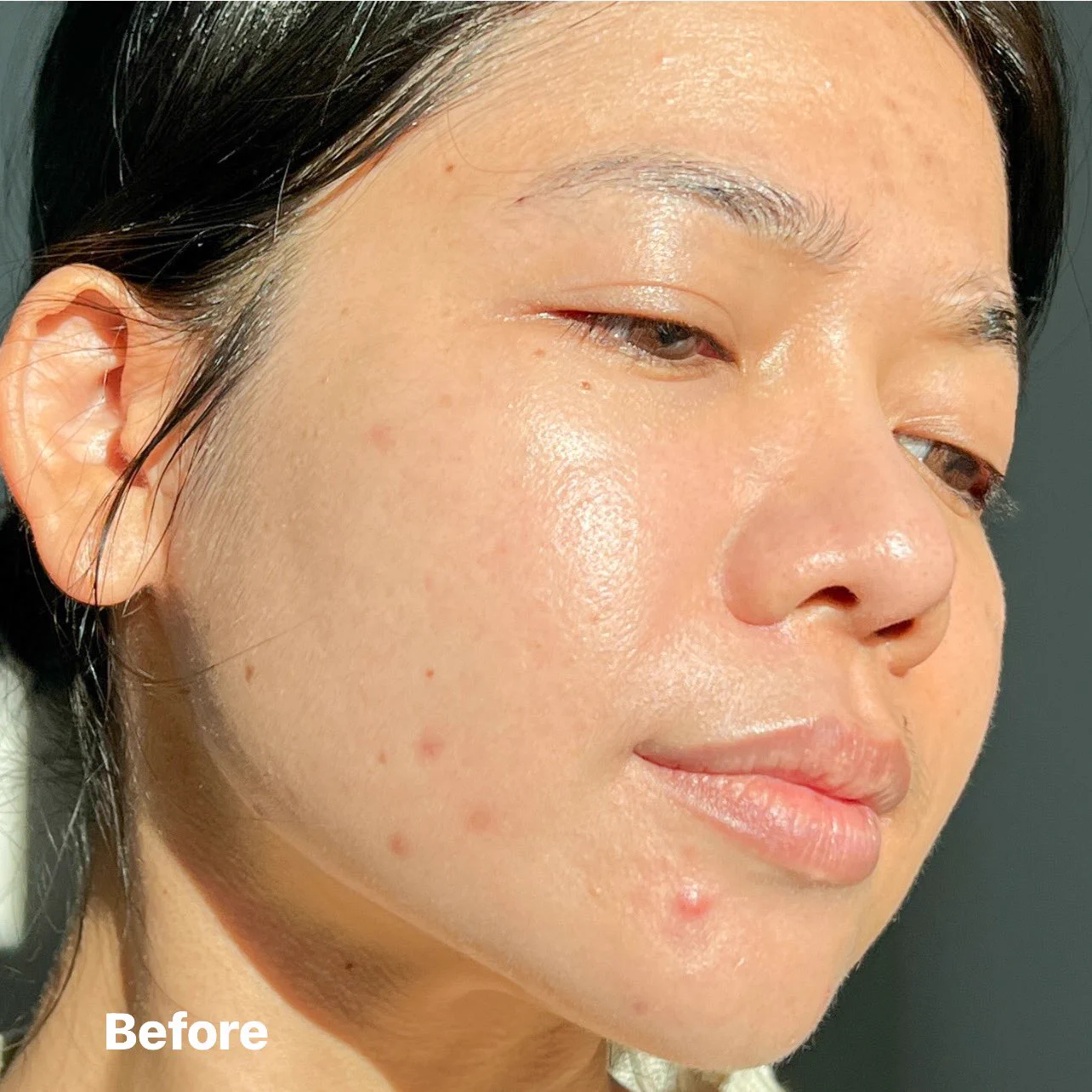 ที่สุดเรื่องลดสิว La Roche-Posay Effaclar Serum ให้ตัวนี้ยืนหนึ่งง ใช้แล้วสิวลด สิวอุดตันหลุด ผิวเหน้าเนียนขึ้น ใครที่เป็นสิวเรื้อรัง ไม่หายสักทีแนะนำว่าลองเถอะ แถมช่วยลดรอยดำรอยแดงจากสิวด้วย ขวดเดียวจบปัญหาสิวจริง!! #ใช้ดีบอกต่อ #LaRochePosayTH #Effaclar #ลาโรชโพเซย์ #เอฟฟาคลาร์ #สลายสิว #เอฟฟาคลาร์เซรั่ม #EffaclarSerum #รอยสิว #สิวอุดตัน