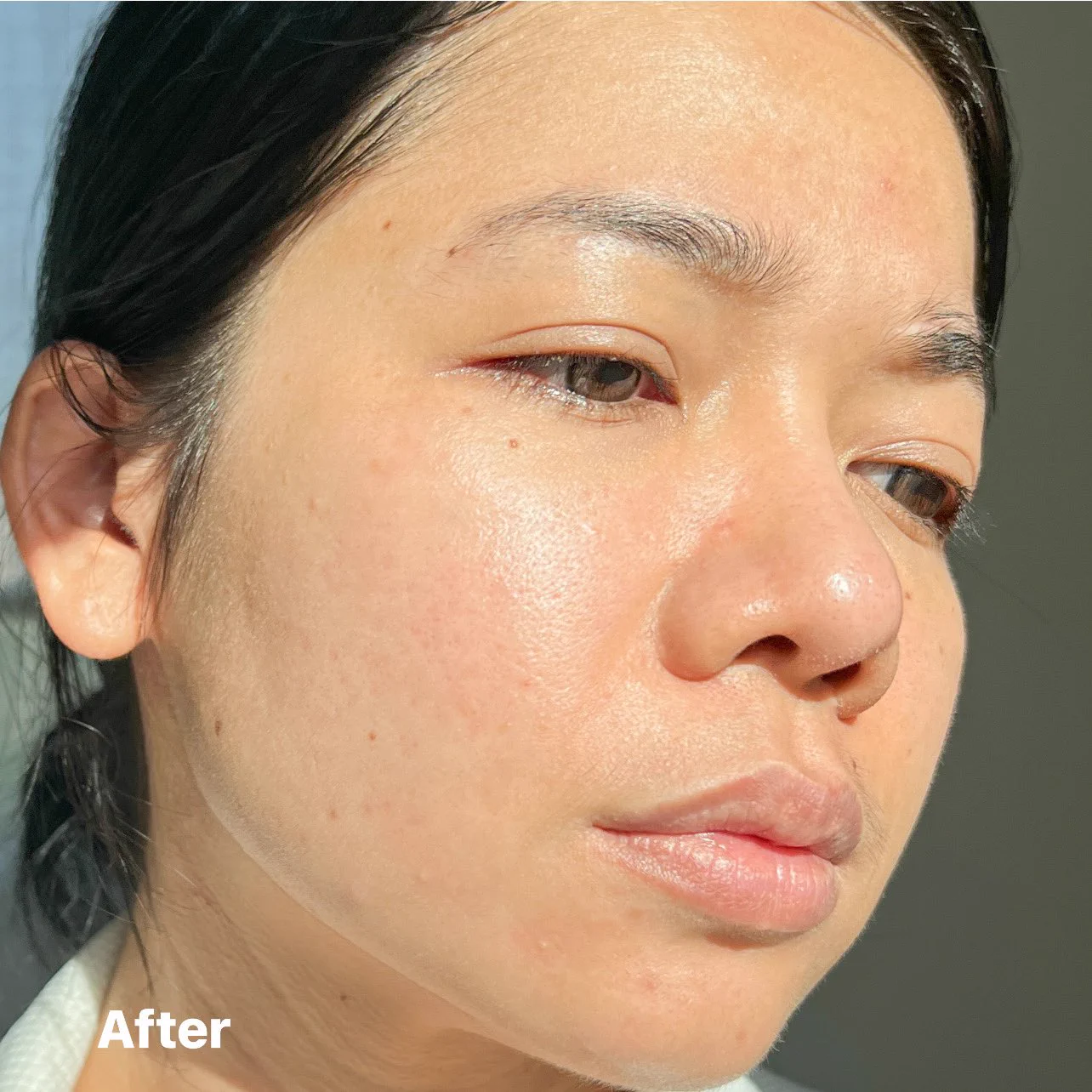 ที่สุดเรื่องลดสิว La Roche-Posay Effaclar Serum ให้ตัวนี้ยืนหนึ่งง ใช้แล้วสิวลด สิวอุดตันหลุด ผิวเหน้าเนียนขึ้น ใครที่เป็นสิวเรื้อรัง ไม่หายสักทีแนะนำว่าลองเถอะ แถมช่วยลดรอยดำรอยแดงจากสิวด้วย ขวดเดียวจบปัญหาสิวจริง!! #ใช้ดีบอกต่อ #LaRochePosayTH #Effaclar #ลาโรชโพเซย์ #เอฟฟาคลาร์ #สลายสิว #เอฟฟาคลาร์เซรั่ม #EffaclarSerum #รอยสิว #สิวอุดตัน