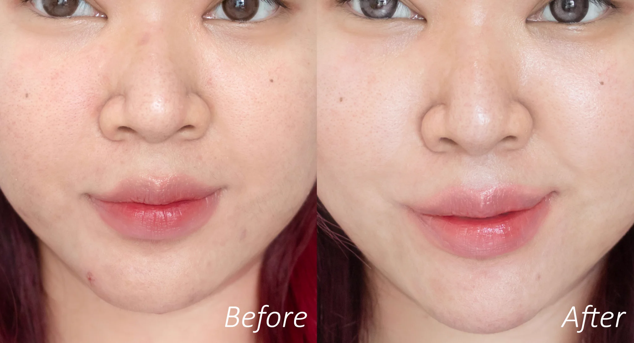 สิวขึ้นง่าย สิวไม่หาย เริ่มใช้แค่ 2 ตัว Effaclar ของลาโรชโพเซย์ ดีแบบดีตะโกน เป็นสิวซ้ำๆ สิวอักเสบไม่มีหัว รอยสิวไม่หายไปตำเถอะ เจลล้างหน้า Micro-Peeling Gel กับ Effaclar Duo+M สิวหายไวสุด รอยสิวก็จาง แล้วคนแต่งหน้าบ่อยๆ สิวคางขึ้นง่าย ใช้ Duo+M สิวไม่ขึ้นซ้ำ ลูกรักสุดผิวเป็นสิว#LaRochePosayTH #Effaclar #ลาโรชโพเซย์ #เอฟฟาคลาร์ #เอฟฟาคลาร์ดูโอพลัสเอ็ม #ลดสิว #รอยสิว #EffaclarPeelingGel #EffaclarDuo #ผิวมัน