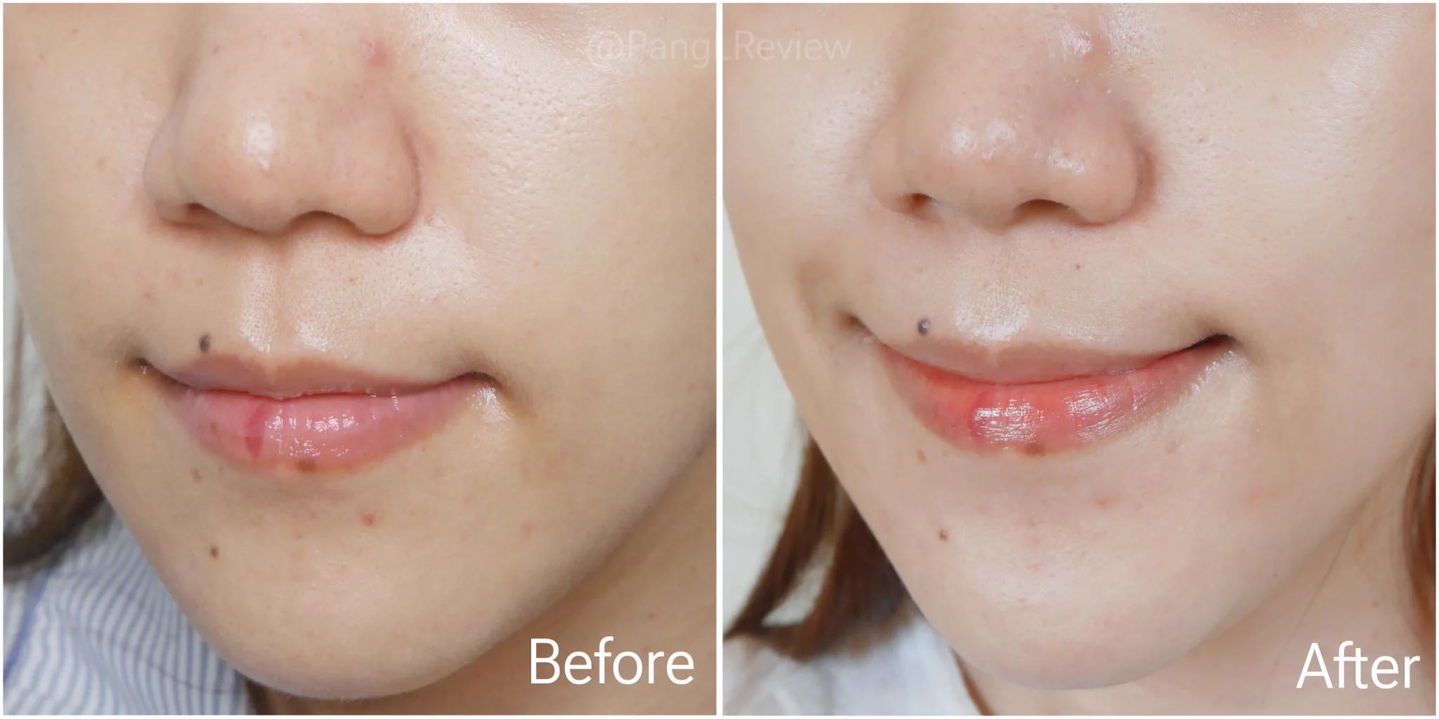 มอยส์เจอร์ที่ใช้แล้วต้องซ้ำ อย่าง EFFACLAR DUO+M หลอดนี้เป็นสูตรใหม่ เป็นสูตรสำหรับคนผิวมันเป็นสิวง่าย แป้งจะใช้ช่วงที่ผิวเป็นสิว พอสิวแห้งจนเริ่มจะทิ้งรอยก็จะใช้มอยส์ตัวนี้ เค้าช่วยลดรอยดำรอยแดงจากสิวได้ชัดเจนเลย ด้วย PHYLOBIOMA ซึ่งเป็นเทคโนโลยีที่ช่วยปรับสมดุลผิวให้สิวขึ้นน้อยลง ลดความมันส่วนเกินบนผิว ที่เป็นปัญหาหลักของการเกิดสิว📌 https://t.co/sWAwnZX8Pu 📌 https://t.co/WvX78fVtmP #LaRochePosayTH #Effaclar #ลาโรชโพเซย์ #เอฟฟาคลาร์ #เอฟฟาคลาร์ดูโอพลัสเอ็ม #ลดสิว #รอยสิว #EffaclarDuo #ผิวมัน