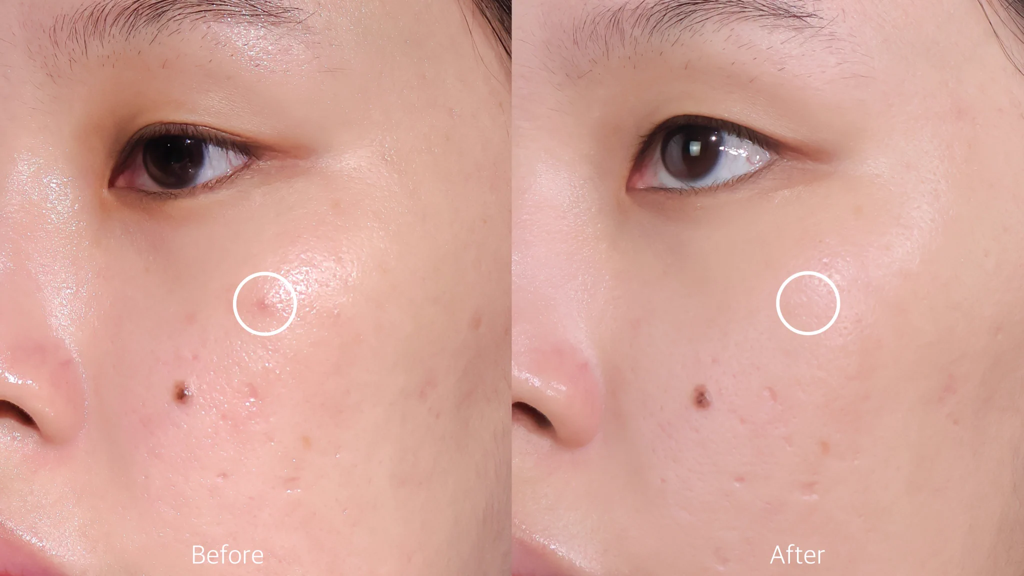 ทุกวันนี้เวลาสิวขึ้น เราจะชอบหยิบ effaclar duo+m มาแต้มทาตลอด มันเคลียร์เร็วอะ จบใน 1 หลอดดี ถ้าอักเสบก็แห้งยุบไป ถ้าอุดตันก็ดันออกไม่ทิ้งรอย โคตรจะปึ้ง แล้วยังช่วยลดความมัน ปรับสมดุลผิวให้สิวขึ้นน้อยลง ลดการเกิดสิวซ้ำซาก รอยดำจากสิวก็จางลงอีก เป็นเนื้อเจลสบายๆ ซึมไว ไม่เหนอะเลย หยิบกี่ทีก็อิน🥺#LaRochePosayTH #Effaclar #ลาโรชโพเซย์ #เอฟฟาคลาร์ #เอฟฟาคลาร์ดูโอพลัสเอ็ม #ลดสิว #รอยสิว #EffaclarDuo #ผิวมัน