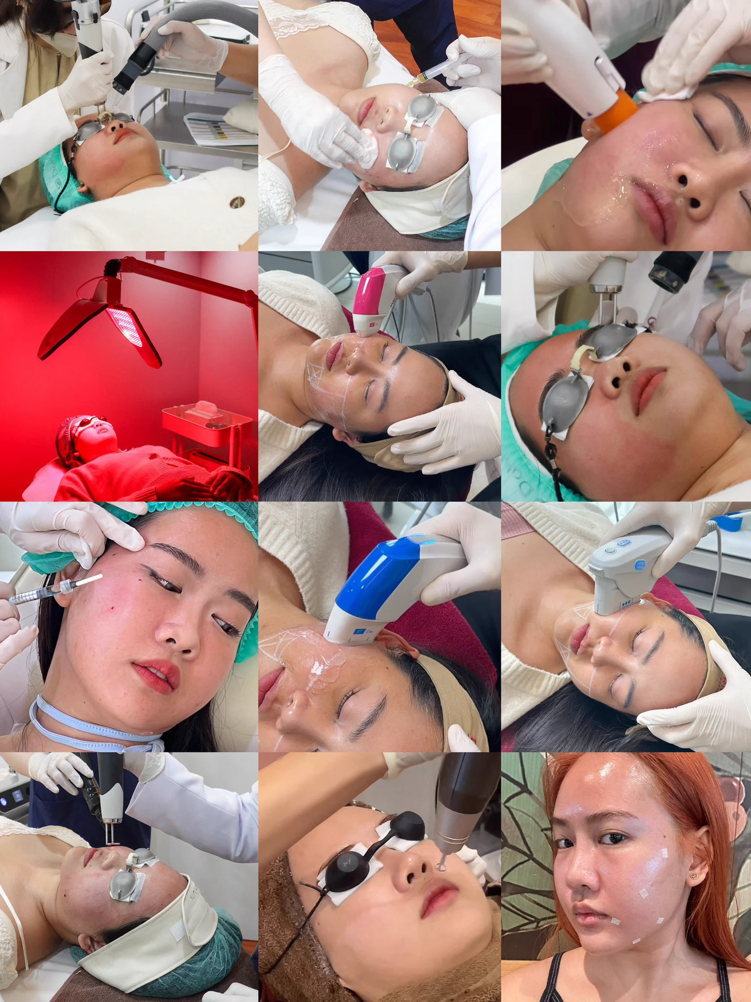 ความลับที่ทำให้ผิวดีที่จริงแล้วคือการทำหัตการ แต่ๆๆของนี่ไม่ได้พึ่งหมออย่างเดียวกลับบ้านมาก็ขยันทาสกินแคร์สุดด คืออยากผิวเด็กไง ล่าสุดเครซี่เซรั่มตัวนึงมากก Eucerin EPICELLINE® Serum พัฒนามาจาก Epigenetic Science เพื่อแก้ปัญหาผิวแก่ได้ตรงจุดถึงระดับเซลล์ ที่ลองจาเห็นผลชัด ใช้มา 4 วีคแล้วผิวเรียบเนียนเด้งฟู ยิ่งใช้หลังทำหัตถการมาผิวยิ่งแน่นยิ่งเริ่ดดด