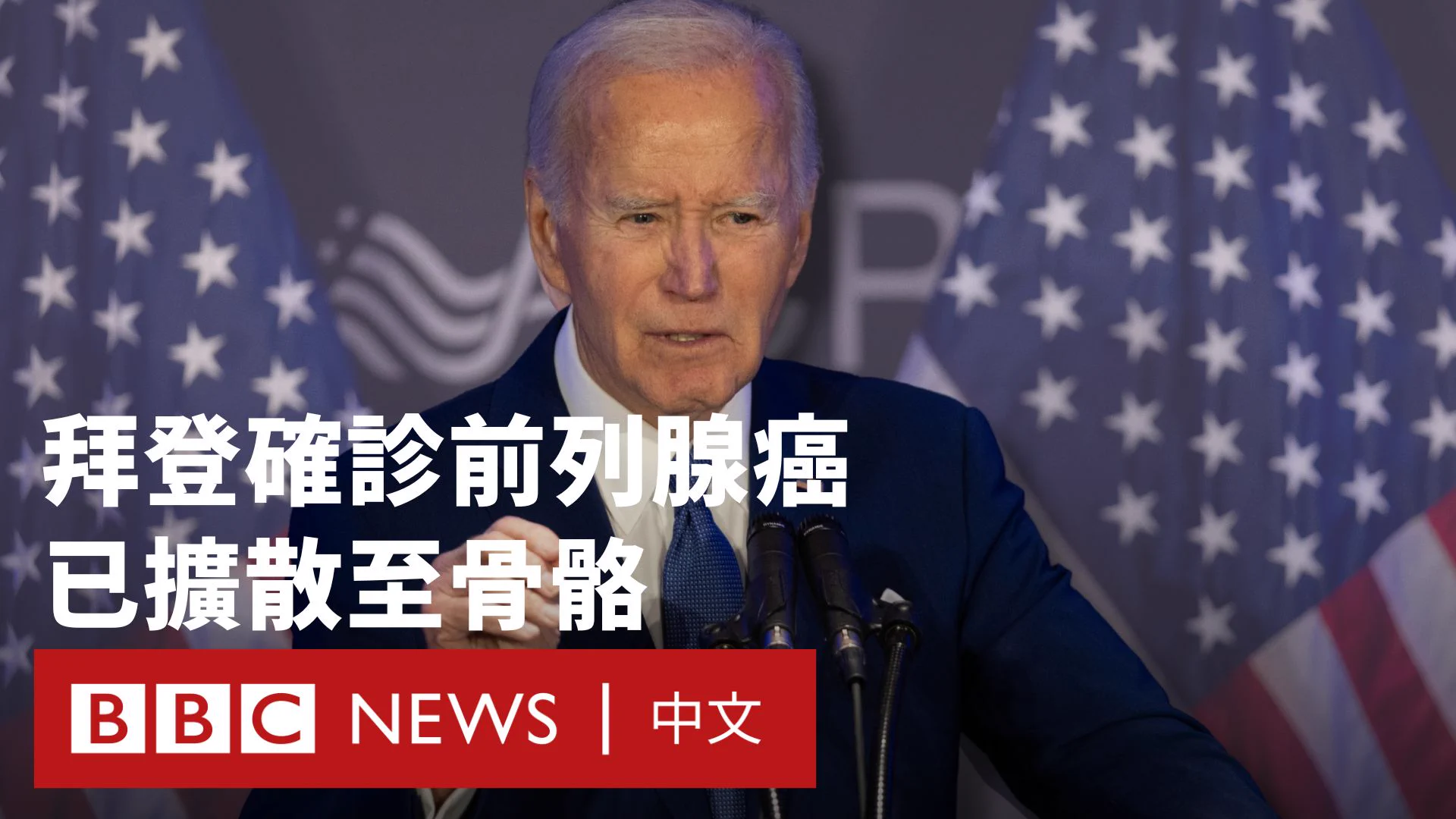 美国前总统拜登日前因泌尿系统症状就诊，经检查后确诊为侵略性前列腺癌，且癌细胞已转移至骨骼。现年82岁的他，是美国历史上最高龄的总统，其健康状况长期受到外界关注。医学教授表示，这类癌症无法治愈，但若仍对荷尔蒙疗法敏感，治疗初期可能有效控制，平均存活期为五至七年。 https://t.co/4z7NnELPSi