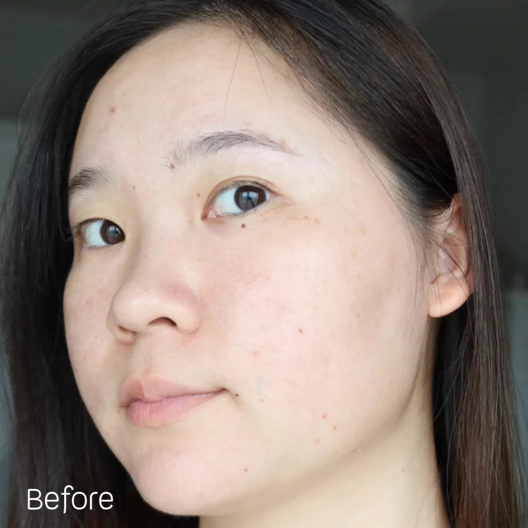 ใครเป็นสิวอุดตัน ไม่ต้องไปบีบไปเค้นให้เจ็บอีกต่อไป~ ลองลาโรชขวดนี้เลยค่า Effaclar serum ตัวนี้ช่วยสลายสิวอุดตัน คือตัดจบปัญหาสิวไปได้เลยเซรั่มจบปัญหาสิวที่ต้นตอ ไม่ว่าจะสิวอักเสบ อุดตัน หรือ สิวเสี้ยน สิวบุกเมื่อไหร่ต้องรีบหยิบตัวนี้มาใช้เลย🩵https://t.co/ud0F0WoKK7 🩵https://t.co/Aj9SGCI2lq#LaRochePosayTH #Effaclar #ลาโรชโพเซย์ #เอฟฟาคลาร์ #สลายสิว #เอฟฟาคลาร์เซรั่ม #EffaclarSerum #รอยสิว #สิวอุดตัน