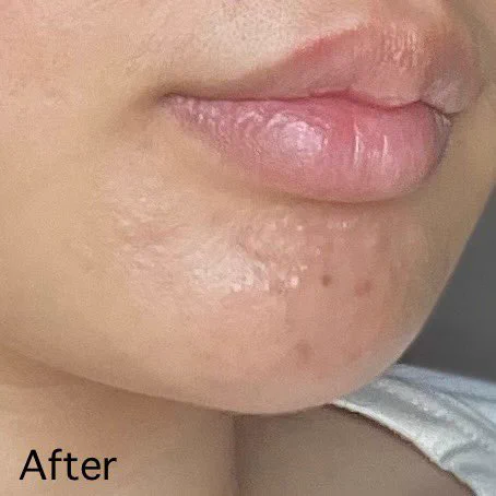 สลายสิวอุดตันตั้งแต่ต้นตอ! La Roche-Posay Effaclar Serum ช่วยผลัดรอยสิว สลายสิวอุดตันดีมาก จัดการทุกความรุนแรงของสิวเลย นี่ชอบที่มี LHA, BHA, Glycolic Acid แล้วใส่ B3 มาปลอบประโลมผิวไปด้วย ใช้แล้วสิวสงบลงมาก แบรนด์นี้เชื่อใจได้จริงๆ ลาสิวได้ด้วยลาโรชโพเซย์💙 https://t.co/5lFkxkMLPD