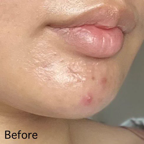 สลายสิวอุดตันตั้งแต่ต้นตอ! La Roche-Posay Effaclar Serum ช่วยผลัดรอยสิว สลายสิวอุดตันดีมาก จัดการทุกความรุนแรงของสิวเลย นี่ชอบที่มี LHA, BHA, Glycolic Acid แล้วใส่ B3 มาปลอบประโลมผิวไปด้วย ใช้แล้วสิวสงบลงมาก แบรนด์นี้เชื่อใจได้จริงๆ ลาสิวได้ด้วยลาโรชโพเซย์💙 https://t.co/5lFkxkMLPD