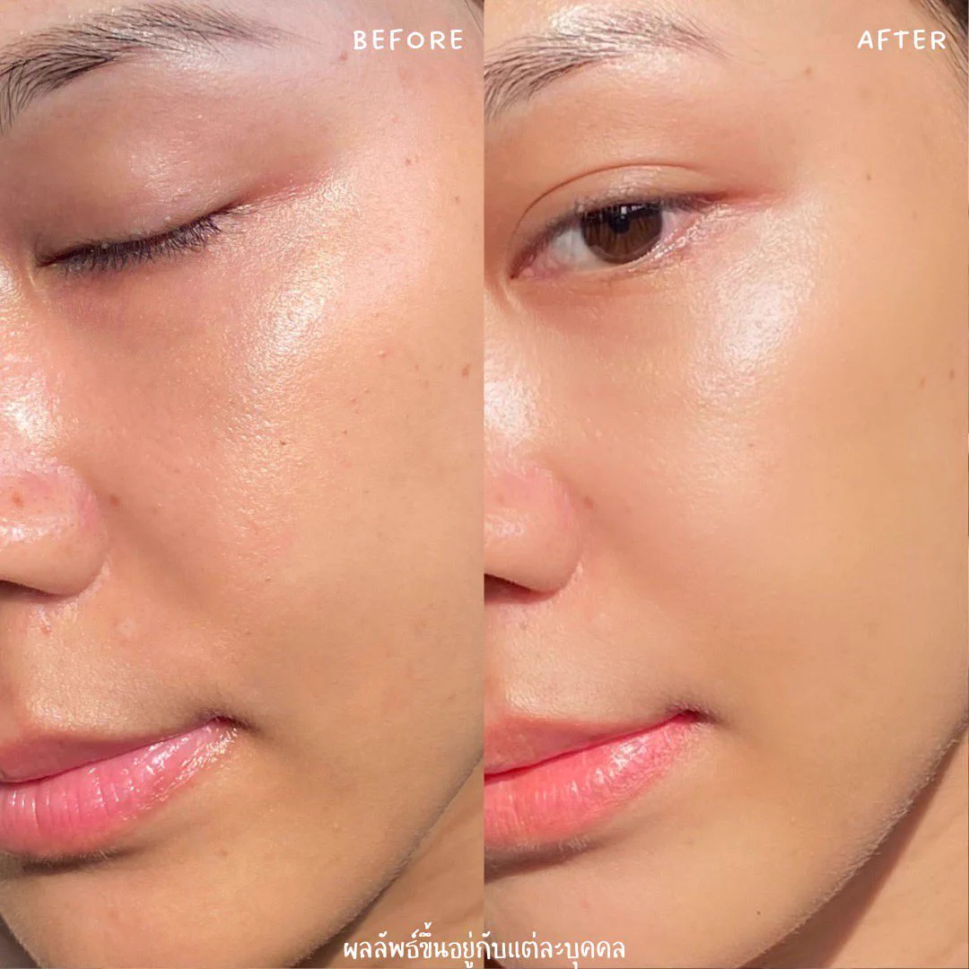 สิวไม่หาย ผิวหมอง รูขุมขนกว้าง ต้องรีเซ็ตผิวเก่าบ้าง
นี่ขอป้ายยา Garnier Tri-Acid Renew Skin Renewal Concentrate💚 มี PHA, AHA, BHA 10%, Niacinamide 5% ช่วยผลัดผิวเก่า + เสริม skin barrier + ปลอบประโลมผิว อ่อนโยนใช้ได้ทุกวัน วิธีใช้คือกดตรงก้นขวด ครั้งละ 3-4 หยดตามด้วยมอยส์ปกติ หลังใช้รู้สึกเหมือนได้ผิวใหม่ รูขุมขนเล็กลง สีผิวสม่ำเสมอ เกราะป้องกันผิวแข็งแรงขึ้น ผิวดีทั้งชั้นนอกชั้นในของจริง ตัวนี้เค้าเหมาะกับทุกสภาพผิวเลยนะ ผิวแพ้ง่ายใช้ได้ แนะนำเลยยย