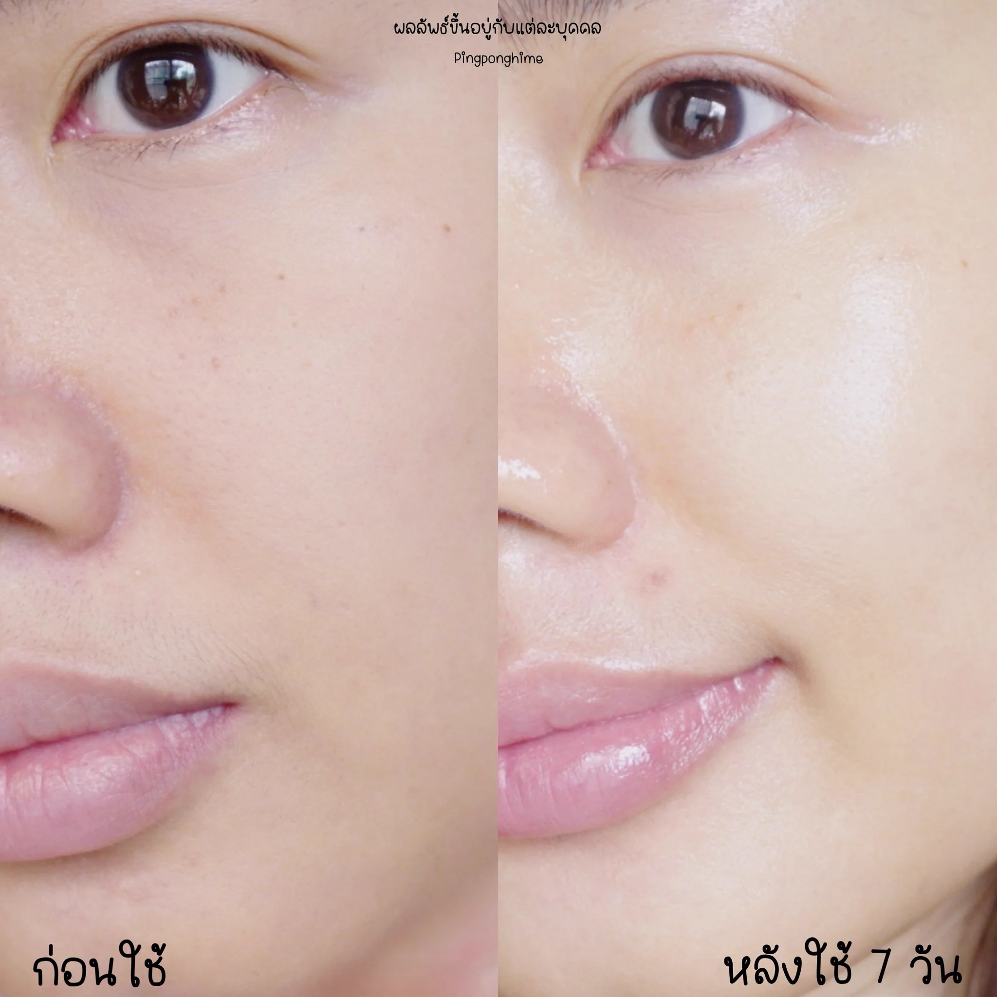 เซรั่มใหม่ของการ์นิเย่ควรแมสม้ากกก! เป็นเซรั่มที่มี AHA BHA PHA และ Niacinamide ช่วยผลัดผิวอย่างอ่อนโยน ไม่ระคายเคือง ละผลลัพธ์ดีมาก หน้าเนียนผิวละเอียด และดูใสขึ้น Garnier Tri-Acid Serum สร้างผิวใหม่สุดดด 

ลองใช้มาซักระยะนึงคือรูขุมขนกระชับขึ้นจริง แล้วคือใช้ได้ทุกวันแบบไม่แสบเลย ผิวแพ้ง่ายก็ใช้ได้ วิธีใช้คือแค่กดเบาๆที่ก้นขวด เซรั่มก็จะดรอปออกมา หยดที่แก้มกับหน้าผาก3หยด อีก1หยดที่จมูกกับคาง เท่านี้คือจบบ